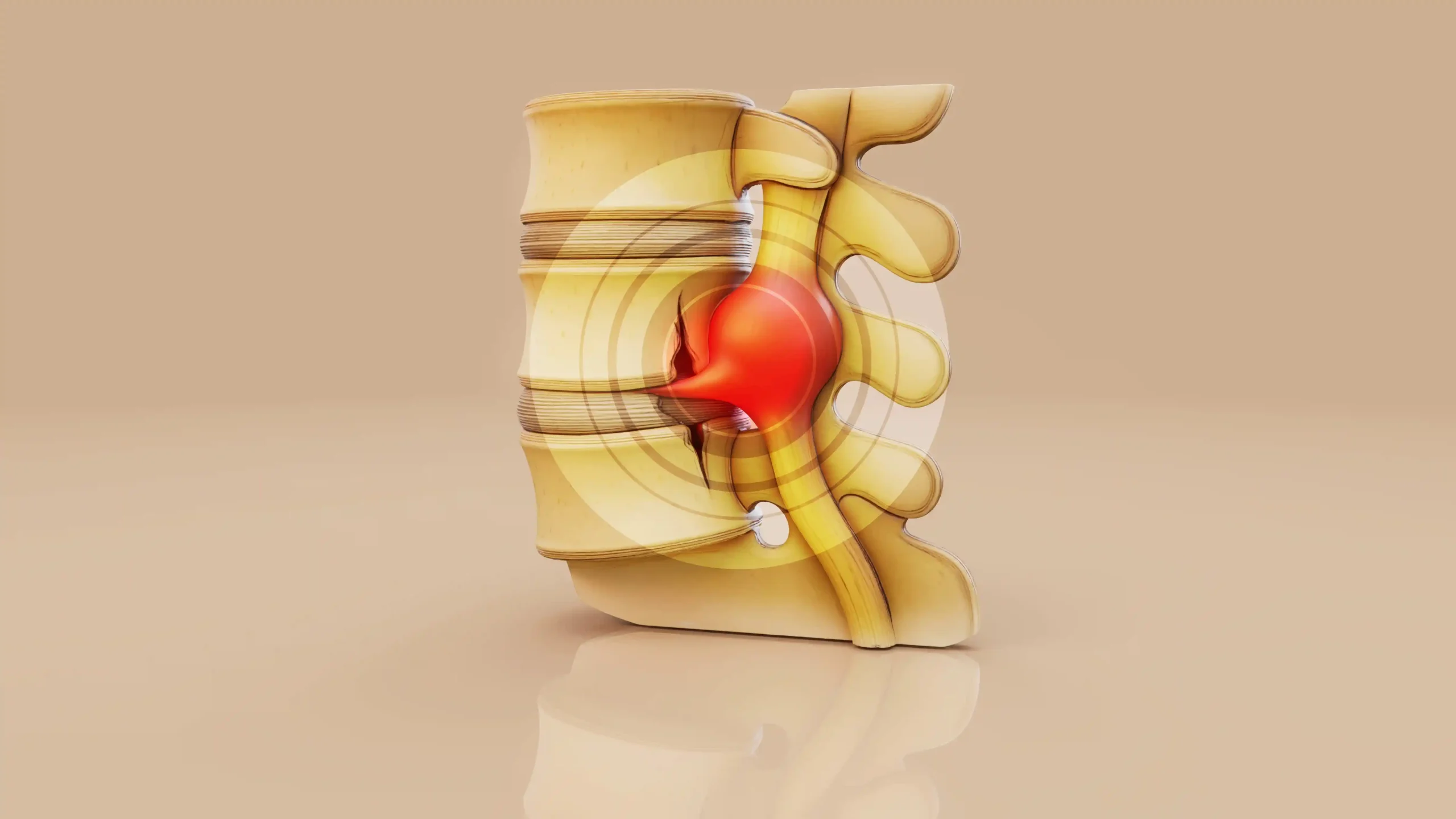 Herniated Disc Treatment: Understanding Your Options for Recovery and Pain Relief 1 Symptoms of a Herniated Disc