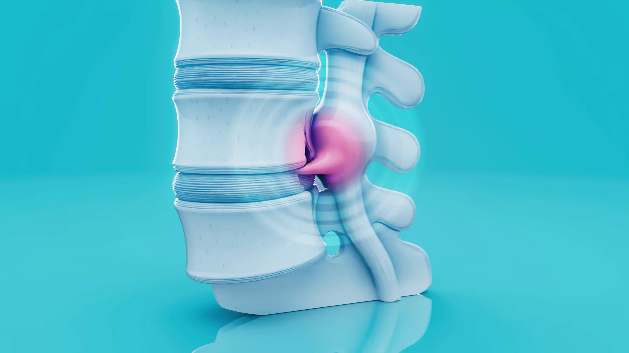 Causes of Degenerative Disc in Lower Back