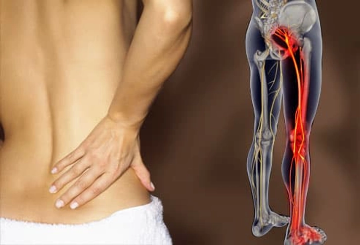 Is Sciatica on Left or Right Side?