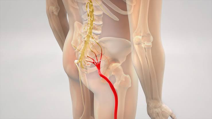 sciatica pain: 7 Symptoms, Causes, Exercises & Relief Tips