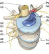 Disc problems showing a herniated lumbar intervertebral disc