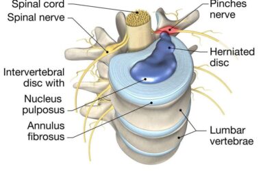 Disc problems showing a herniated lumbar intervertebral disc