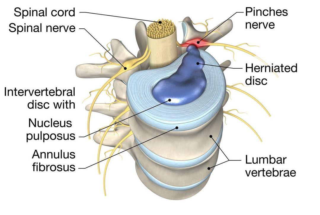 Disc problems showing a herniated lumbar intervertebral disc