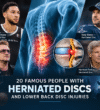 Famous People With Herniated Discs