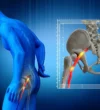 How to Relieve Sciatica Pain While Walking
