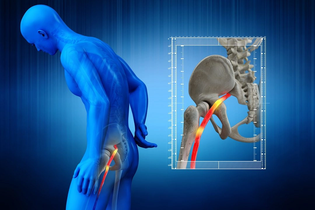 How to Relieve Sciatica Pain While Walking