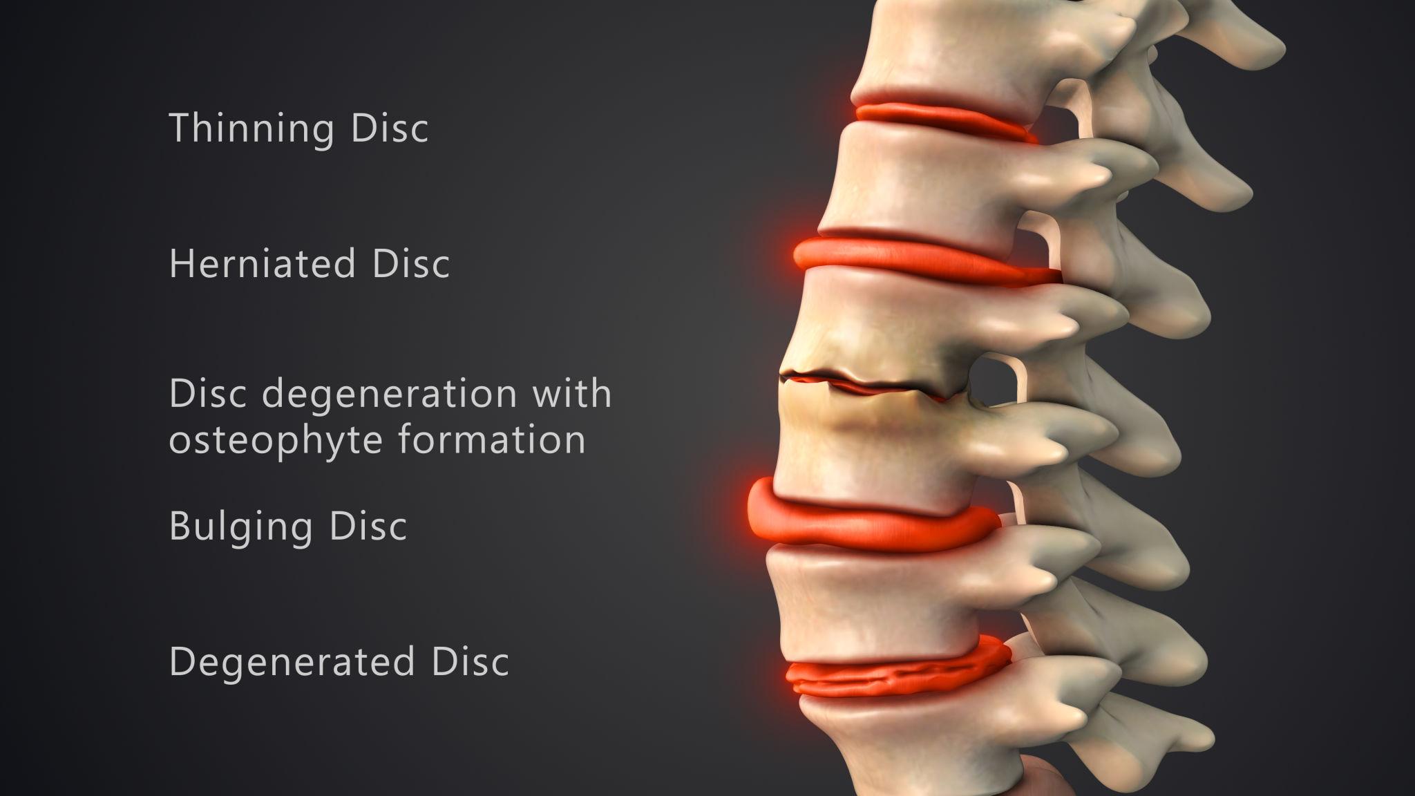 Disc Problems: Causes, Symptoms, and Treatment Options 2 Types of Disc Problems in the Lower Back
